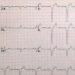 Cardiac Resynchronization Therapy may be more beneficial in women