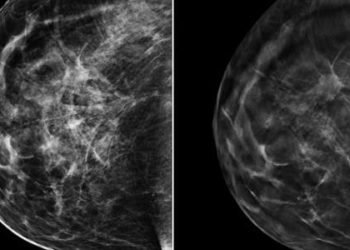 3D mammography (tomosynthesis) enhances accuracy of breast cancer screening