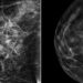 3D mammography (tomosynthesis) enhances accuracy of breast cancer screening