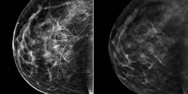 140624-2d-3d-mammograms-jsw-136p_b324f3843fa4547c1925c97fadba01c5.nbcnews-ux-960-800