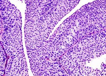 Seminal vesicle invasion predicts decreased survival in bladder cancer