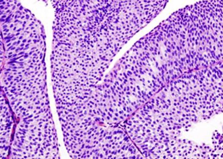 Seminal vesicle invasion predicts decreased survival in bladder cancer