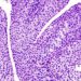 Seminal vesicle invasion predicts decreased survival in bladder cancer