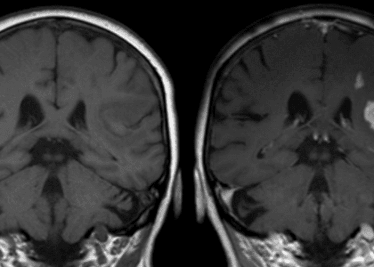 No obesity paradox found between BMI, stroke, and death