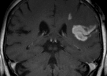 No obesity paradox found between BMI, stroke, and death