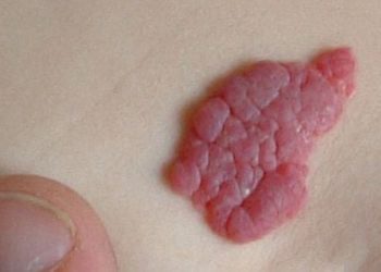 Infrared thermography reliably measures growth of infantile hemangiomas