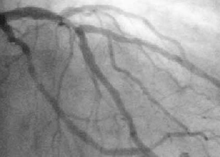 Ultrasound, flow reserve guided coronary interventions provide minimal benefit