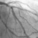 Ultrasound, flow reserve guided coronary interventions provide minimal benefit