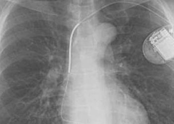 Prophylactic implantable cardioverter-defibrillators may decrease mortality in left ventricular dysfunction