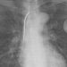 Prophylactic implantable cardioverter-defibrillators may decrease mortality in left ventricular dysfunction