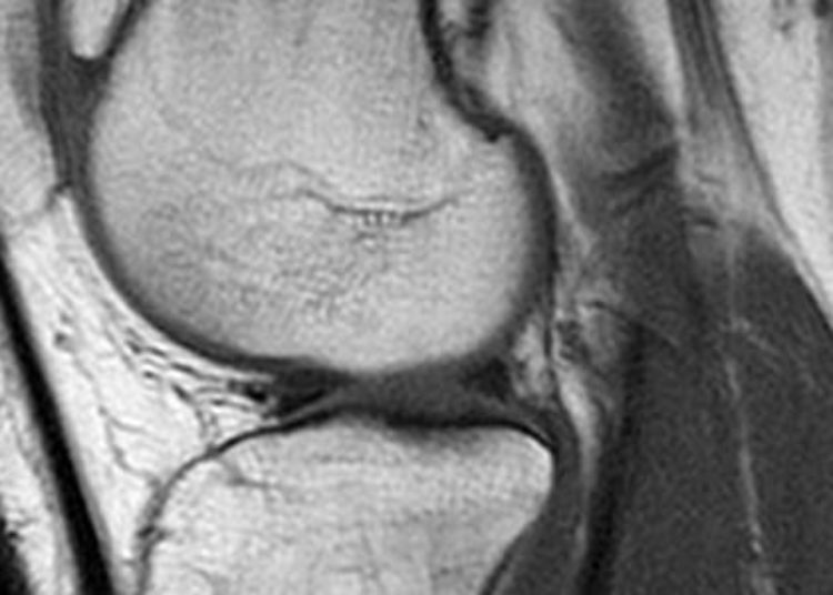 Meniscal allograft transplantation may improve knee function