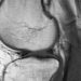 Meniscal allograft transplantation may improve knee function