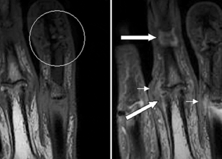 Brodalumab effective in treating active psoriatic arthritis
