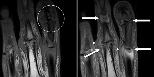 Psoriatic_arthritis_fingers_ar1934-1