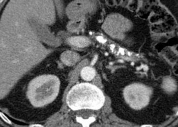 Somatostatin may not reduce risk of pancreatitis post endoscopic retrograde cholangiopancreatography