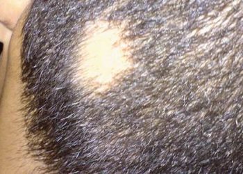 Eosinophilic infiltrates have limited diagnostic utility in alopecia areata