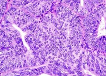 American-born Asian women more likely to have endometrial cancer