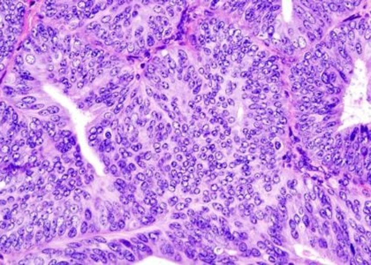 American-born Asian women more likely to have endometrial cancer