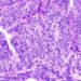 American-born Asian women more likely to have endometrial cancer