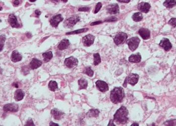 Shorter surveillance follow-up for stage I seminoma may be sufficient