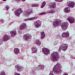 Shorter surveillance follow-up for stage I seminoma may be sufficient