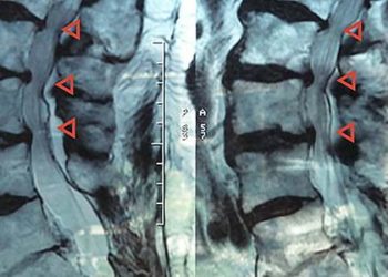 No benefit with glucocorticoid injection for spinal stenosis