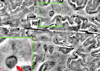 Increased multiple sclerosis relapse after natalizumab (Tysabri) discontinuation (TY-STOP Study)