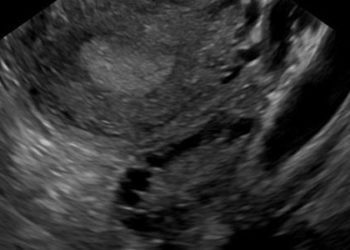 Letrozole (Femara) boosts fertility of women with Polycystic Ovarian Syndrome