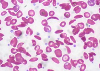 Stem cell transplant may be effective in sickle cell disease