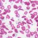 Stem cell transplant may be effective in sickle cell disease