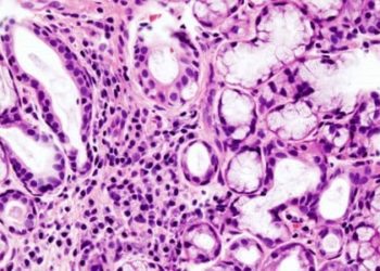 No benefit with hydroxychloroquine (Plaquenil) over placebo in Sjogren’s Syndrome [JOQUER Trial]