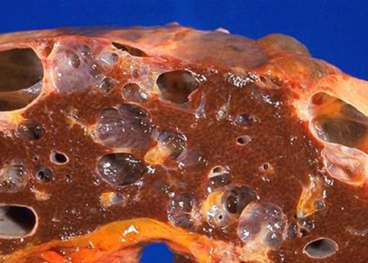 Elevated troponin in chronic kidney disease associated with increased mortality