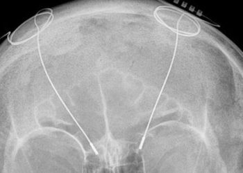 Deep brain stimulation may be safe for older Parkinson patients