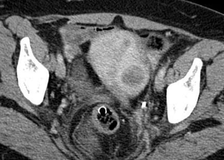 Contained morcellation for benign gynecologic surgeries feasible, minimize surgical risk