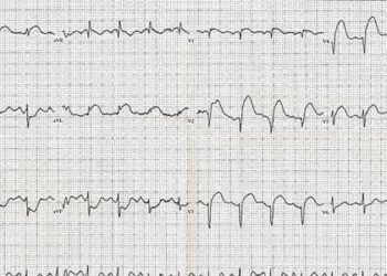 Chest pain may be better than EKG, echo for predicting coronary artery disease prognosis