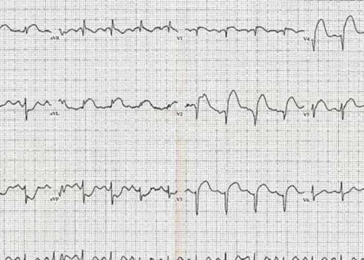 Chest pain may be better than EKG, echo for predicting coronary artery disease prognosis