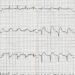 Chest pain may be better than EKG, echo for predicting coronary artery disease prognosis