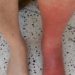 Dermatological consultation in outpatients improves diagnosis of cellulitis