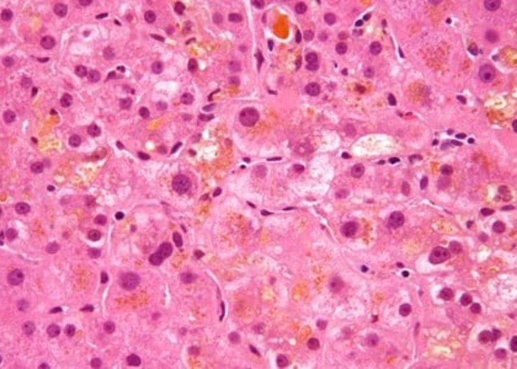 Intrahepatic cholestasis of pregnancy linked to poor outcomes