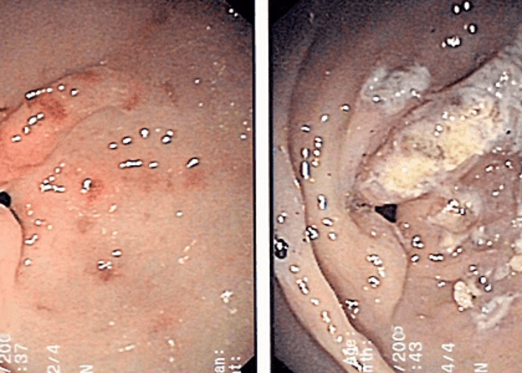 Radiofrequency ablation may treat gastric antral vascular atresia