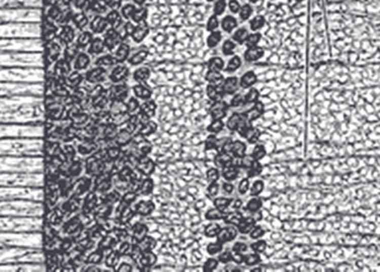 Damage similar in each eye after sequential ischemic optic neuropathy