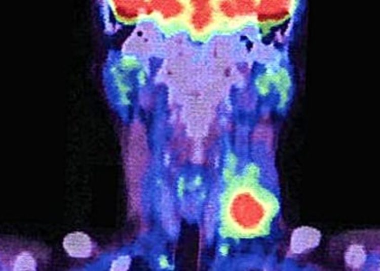 Comorbidities of head and neck cancer may drive malnutrition