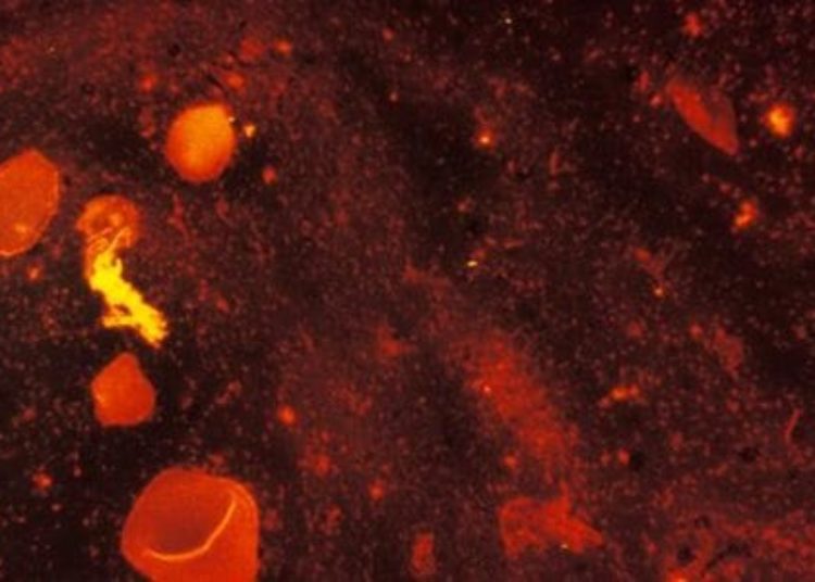 Bedaquiline efficacious in treating multidrug resistant tuberculosis: phase 2 trial