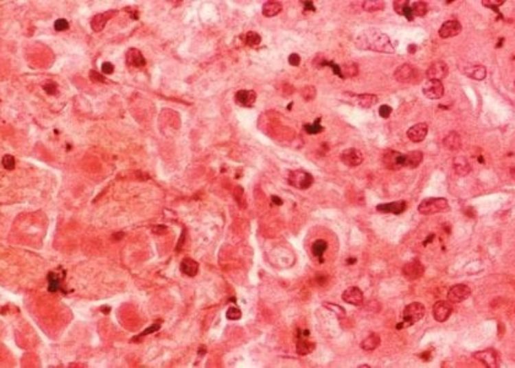 Expanded screening and new treatments may reduce hepatitis C burden