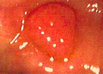 Flexible sigmoidoscopy decreases colorectal cancer incidence and mortality