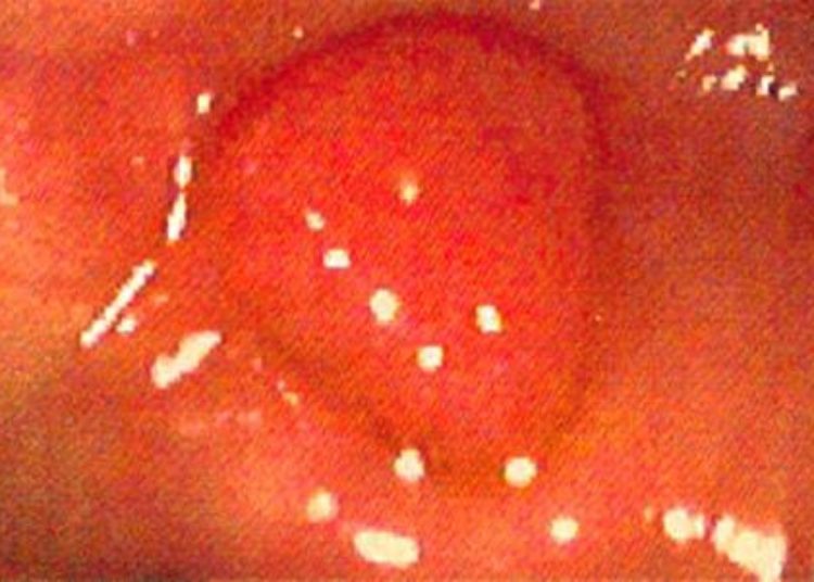 Flexible sigmoidoscopy decreases colorectal cancer incidence and mortality