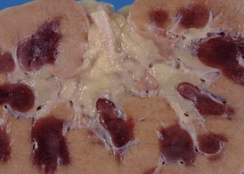 Intravenous contrast may not increase risk of acute kidney injury