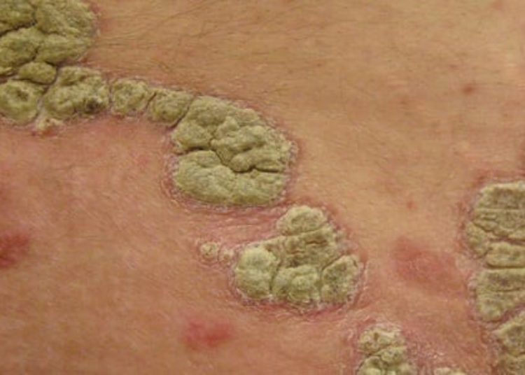 Ixekizumab may be safe and effective for chronic plaque psoriasis