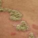 Ixekizumab may be safe and effective for chronic plaque psoriasis