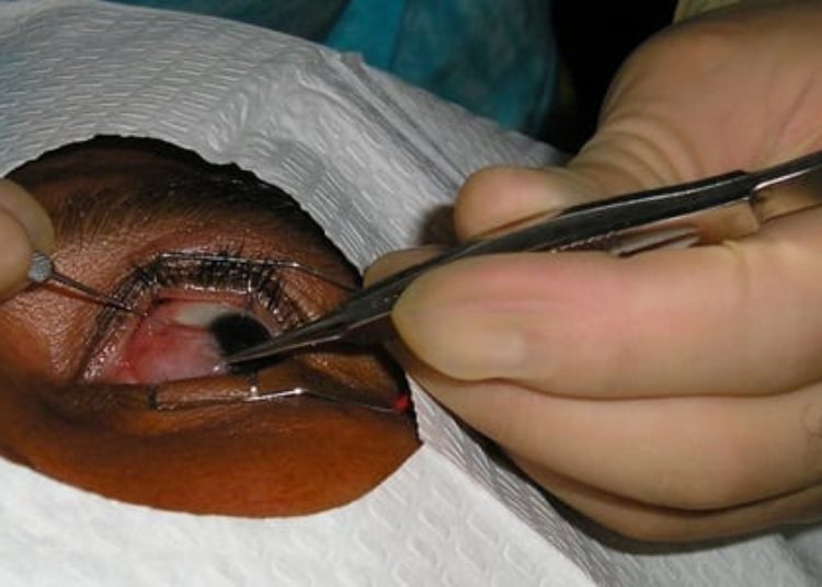 Smoking exposure may decrease risk of developing inner eye growths (pterygium)